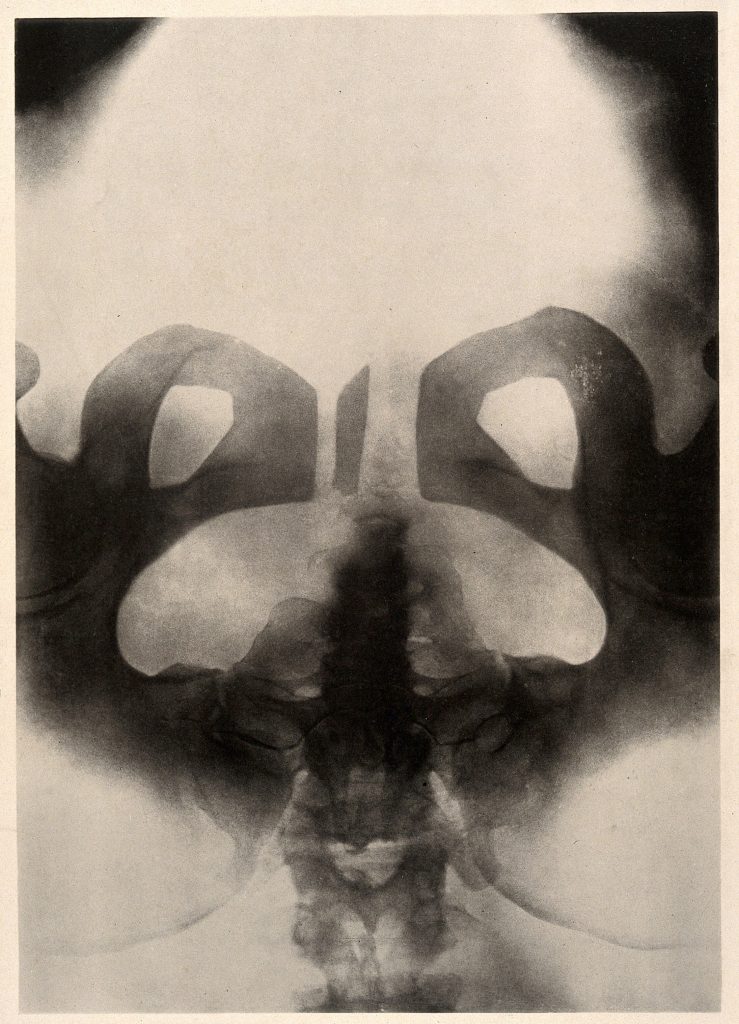 It’s a ‘collotype’, which basically looks like a fuzzy x-ray, of a pelvis. Smudgy black and white, it’s not immediately obvious to non-medically trained eyes what we’re looking at, but after a while it seems that it’s upside-down, with the little tail bone sticking upwards, hips curling inwards.